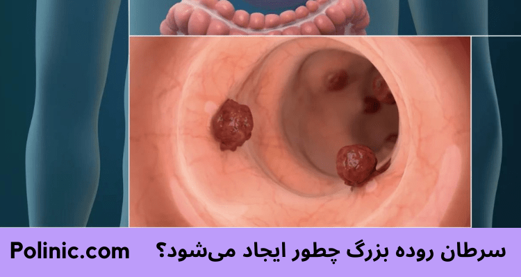 سرطان روده بزرگ چطور ایجاد می‌شود؟